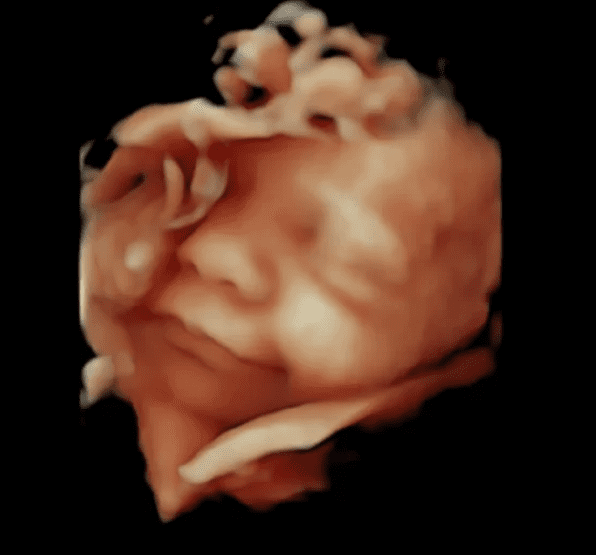 Échographie 3D — visage fœtal